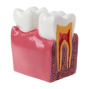 6 Kartus Dantų Ėduonies Comparation Anatomija Dantų Modelio Dantų Anatomija Lab Mokymo Studijuoja mokslinius Tyrimus Įrankis