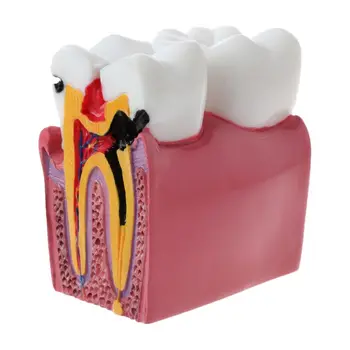 6 Kartus Dantų Ėduonies Comparation Anatomija Dantų Modelio Dantų Anatomija Lab Mokymo Studijuoja mokslinius Tyrimus Įrankis
