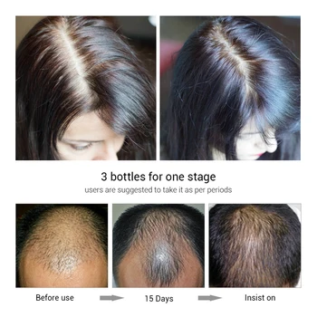 Plaukų Augimo Esmė Purškimo Prevencijos Nuplikimas Stiprinant Kovos Su Plaukų Slinkimas Stiprus Maitina Plaukų Šaknis, Plaukai Atauga F